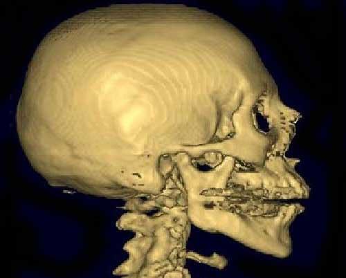 Компьютерная томография лицевых костей черепа