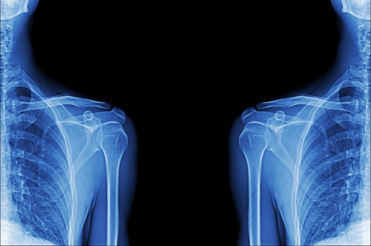 МРТ плечевого сплетения - 4